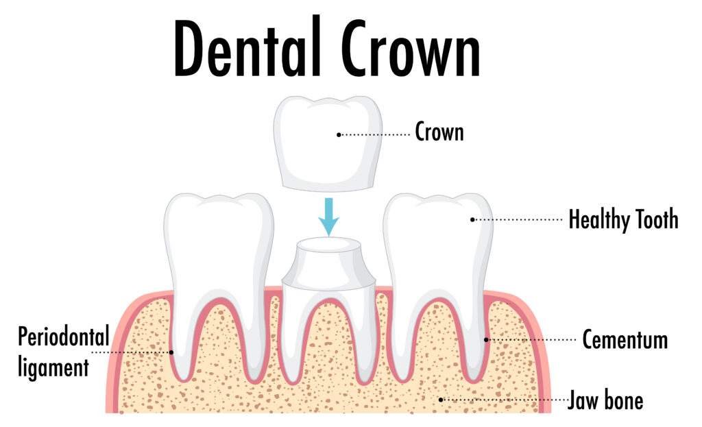 Dental crowns